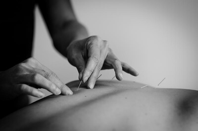 Acupuncture